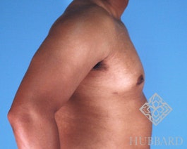 Gynecomastia Before and After | Dr. Thomas Hubbard