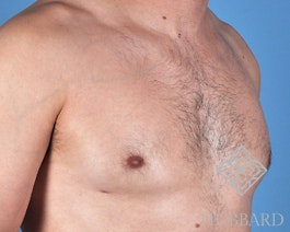 Male Breast Body Before and After | Dr. Thomas Hubbard