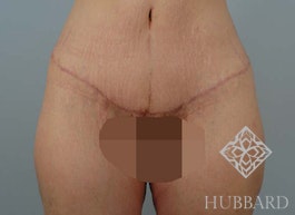 Surgery After Weight Loss Before and After | Dr. Thomas Hubbard
