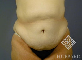 Surgery After Weight Loss Before and After | Dr. Thomas Hubbard