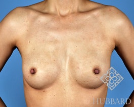 Breast Augmentation Before and After | Dr. Thomas Hubbard
