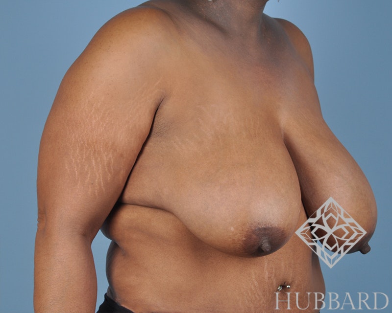 Breast Reduction Before and After | Dr. Thomas Hubbard