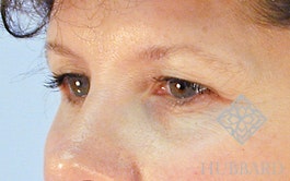 Brow Lift Before and After | Dr. Thomas Hubbard
