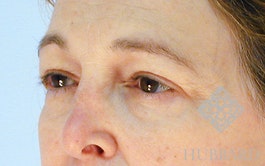 Brow Lift Before and After | Dr. Thomas Hubbard