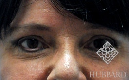 Eyelid Surgery Before and After | Dr. Thomas Hubbard