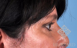 Eyelid Surgery Before and After | Dr. Thomas Hubbard