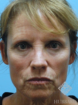 Face Lift Before and After | Dr. Thomas Hubbard