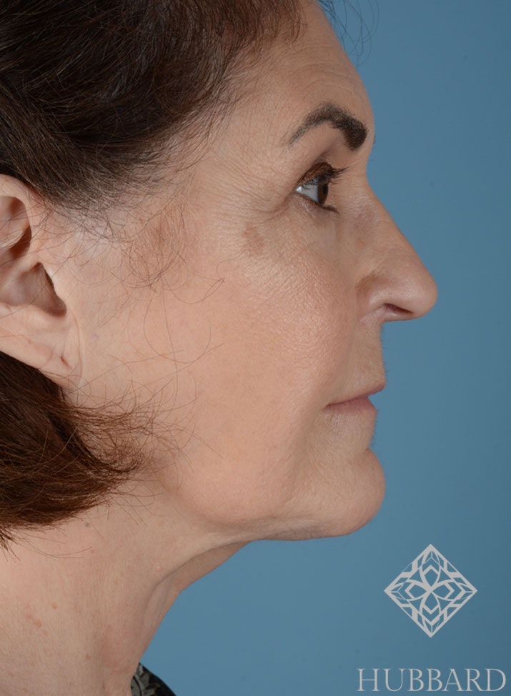 Face Lift Before and After | Dr. Thomas Hubbard