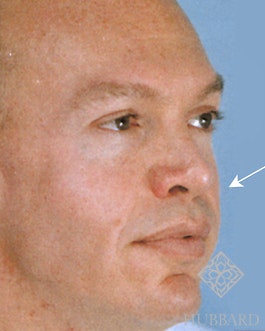 Facial Implants Before and After | Dr. Thomas Hubbard