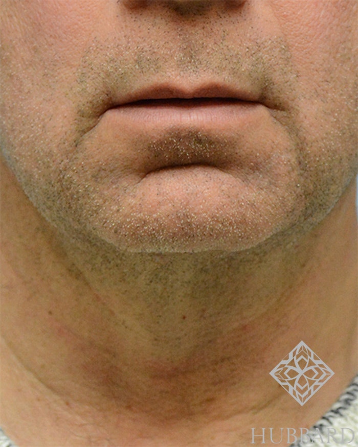 Facial Implants Before and After | Dr. Thomas Hubbard