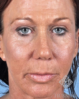 Laser Skin Resurfacing Before and After | Dr. Thomas Hubbard