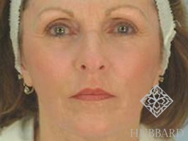 Laser Skin Resurfacing Before and After | Dr. Thomas Hubbard