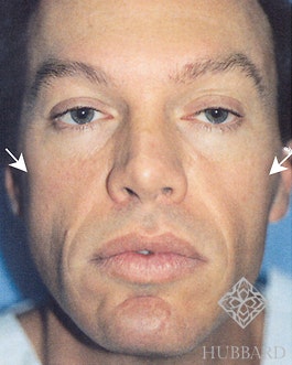 Male Face Procedures Before and After | Dr. Thomas Hubbard