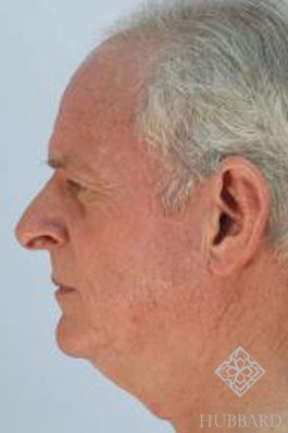 Neck Lift Before and After | Dr. Thomas Hubbard