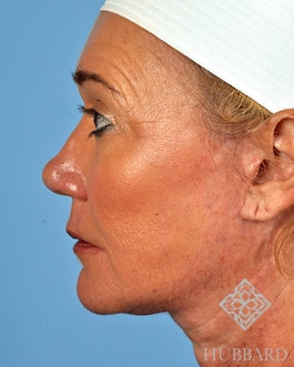 Neck Lift Before and After | Dr. Thomas Hubbard
