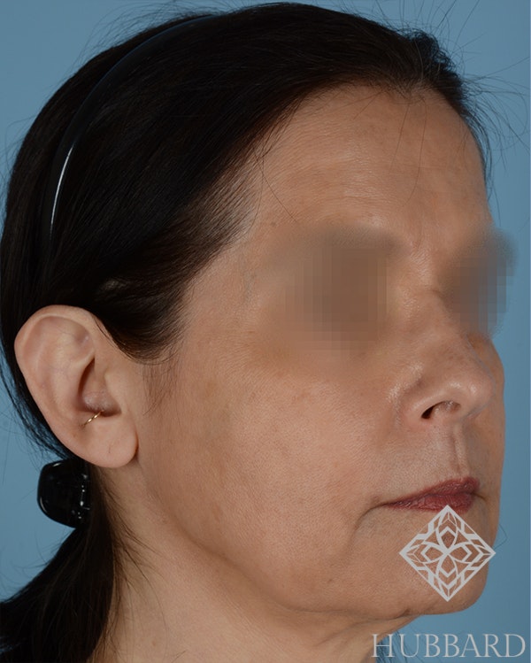 Otoplasty Before and After | Dr. Thomas Hubbard