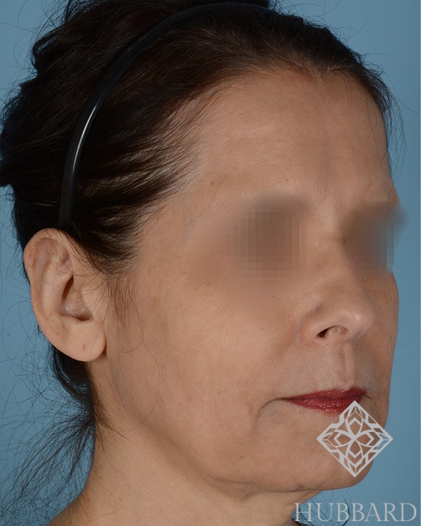 Otoplasty Before and After | Dr. Thomas Hubbard