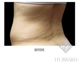 Coolsculpting Before and After | Dr. Thomas Hubbard