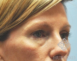 Injectable Fillers Before and After | Dr. Thomas Hubbard