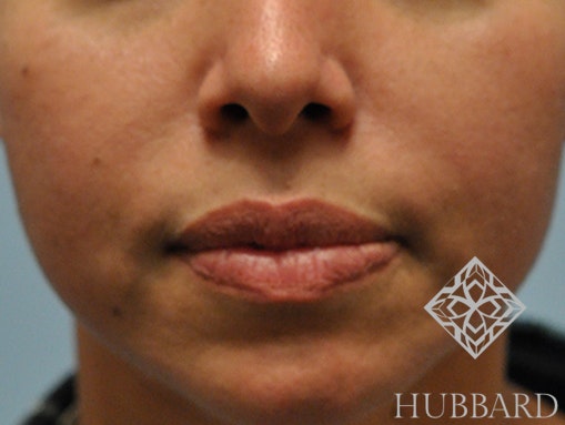 Injectable Fillers Before and After | Dr. Thomas Hubbard