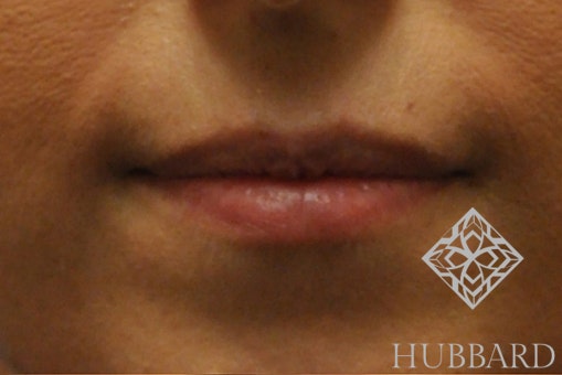 Lip Enhancement Before and After | Dr. Thomas Hubbard