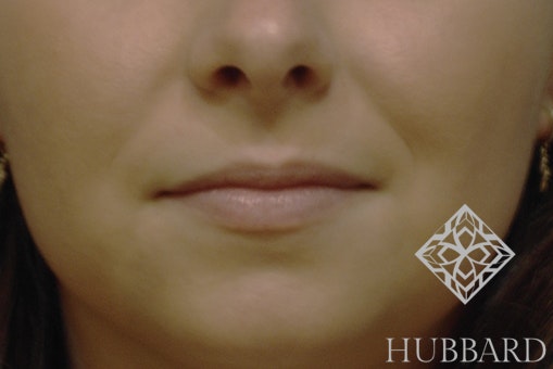 Lip Enhancement Before and After | Dr. Thomas Hubbard